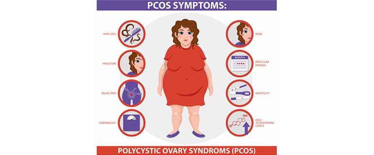 POLYCYSTIC OVARY SYNDROME (PCOS)