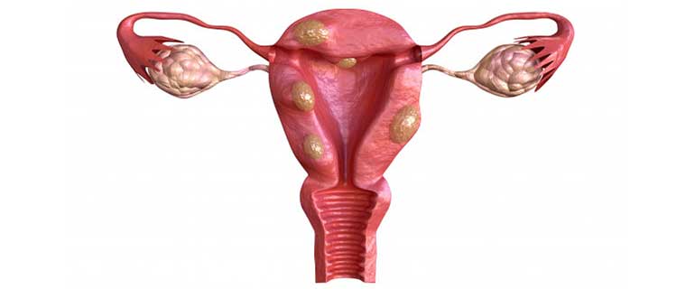 UTERINE FIBROIDS: EVERYTHING YOU NEED TO KNOW